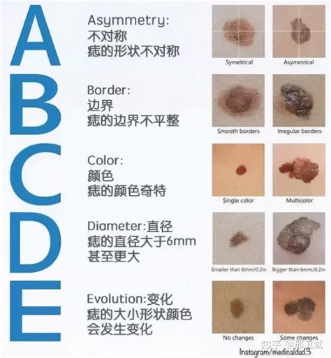 有問題的痣|痣有4種顏色，出現在「手腳這邊」的痣可能是皮膚。